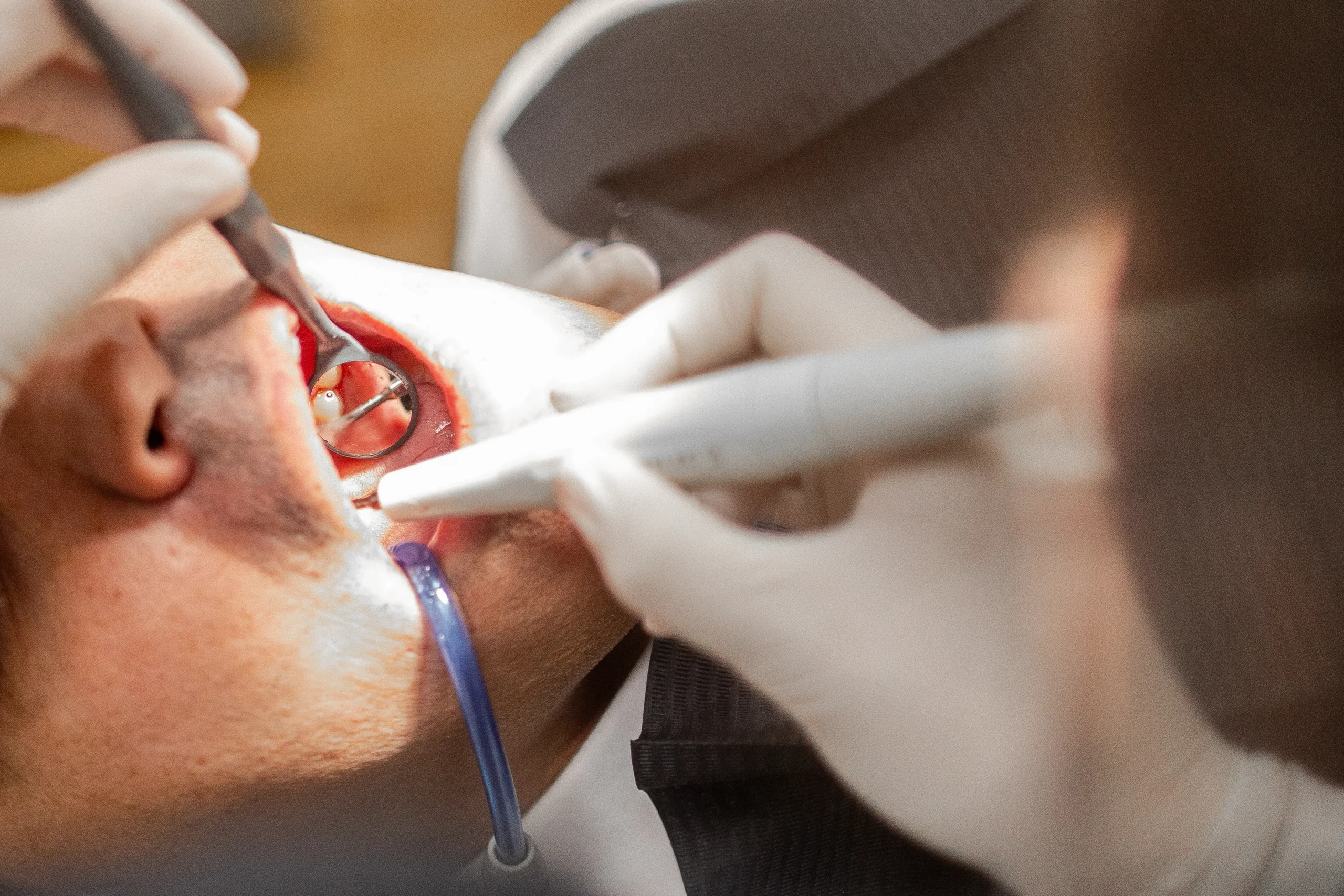 Dental Implants Malaga, What the Process is Like 1 Dental implants Malaga, what the process is like