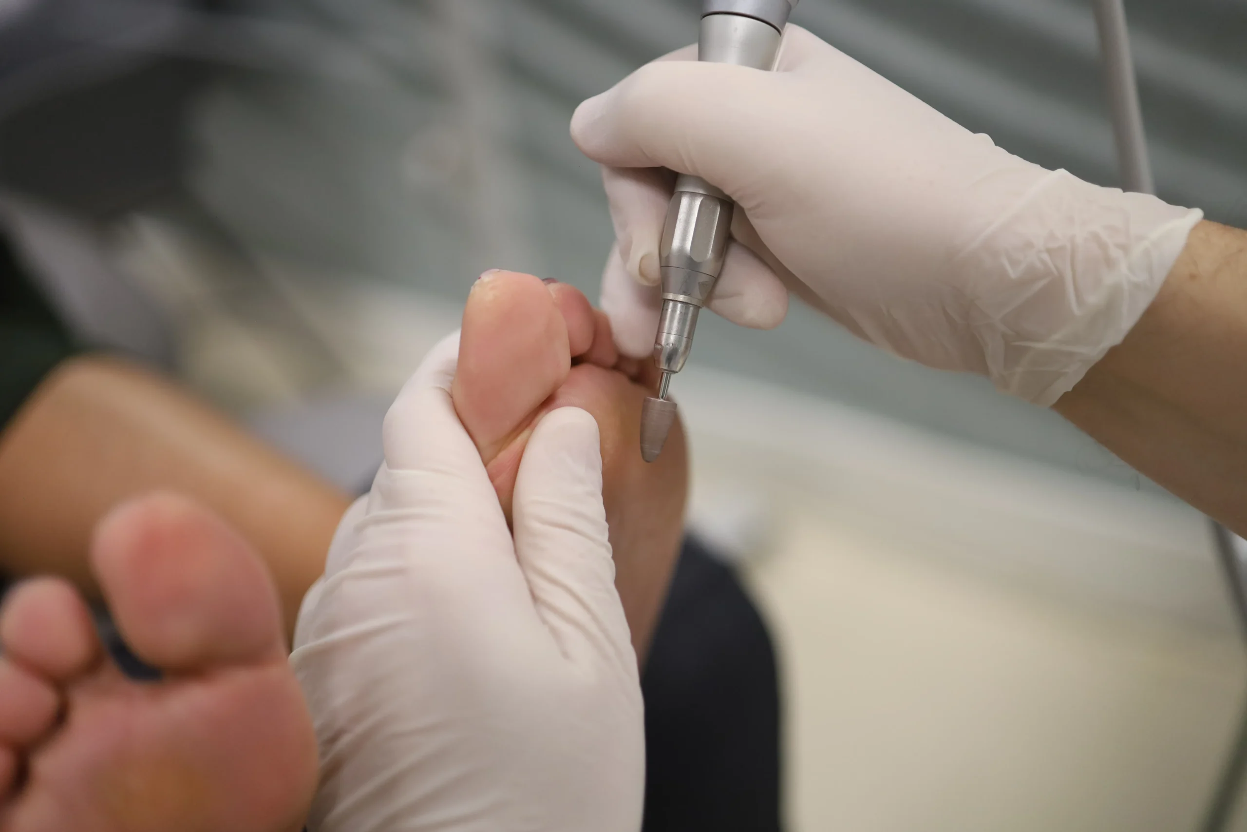 Corte de uñas en podología, el corte de uñas profesional