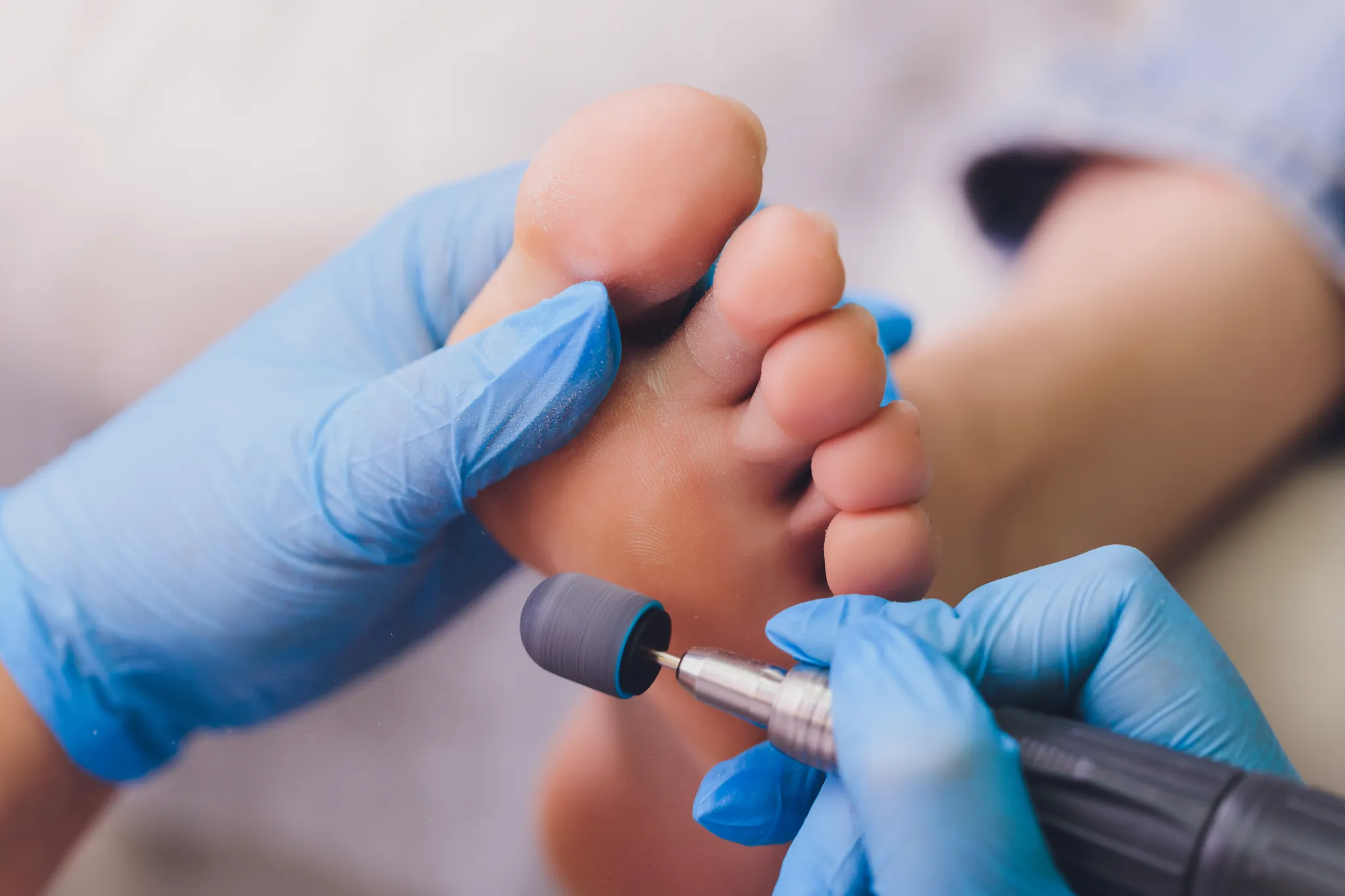 Deformidades en los dedos del pie