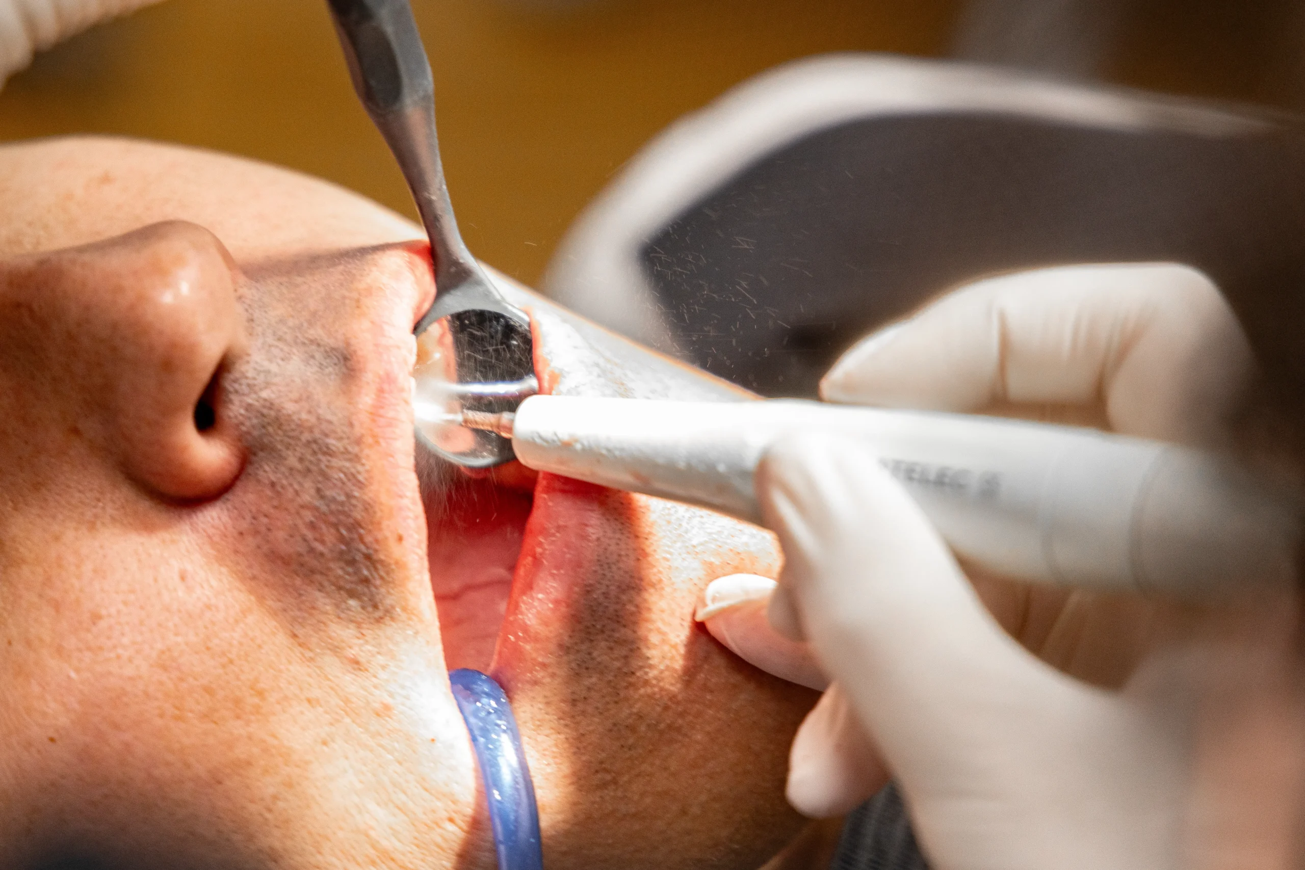 Tooth Sensitivity, how it Occurs 2 Tooth sensitivity, how it occurs