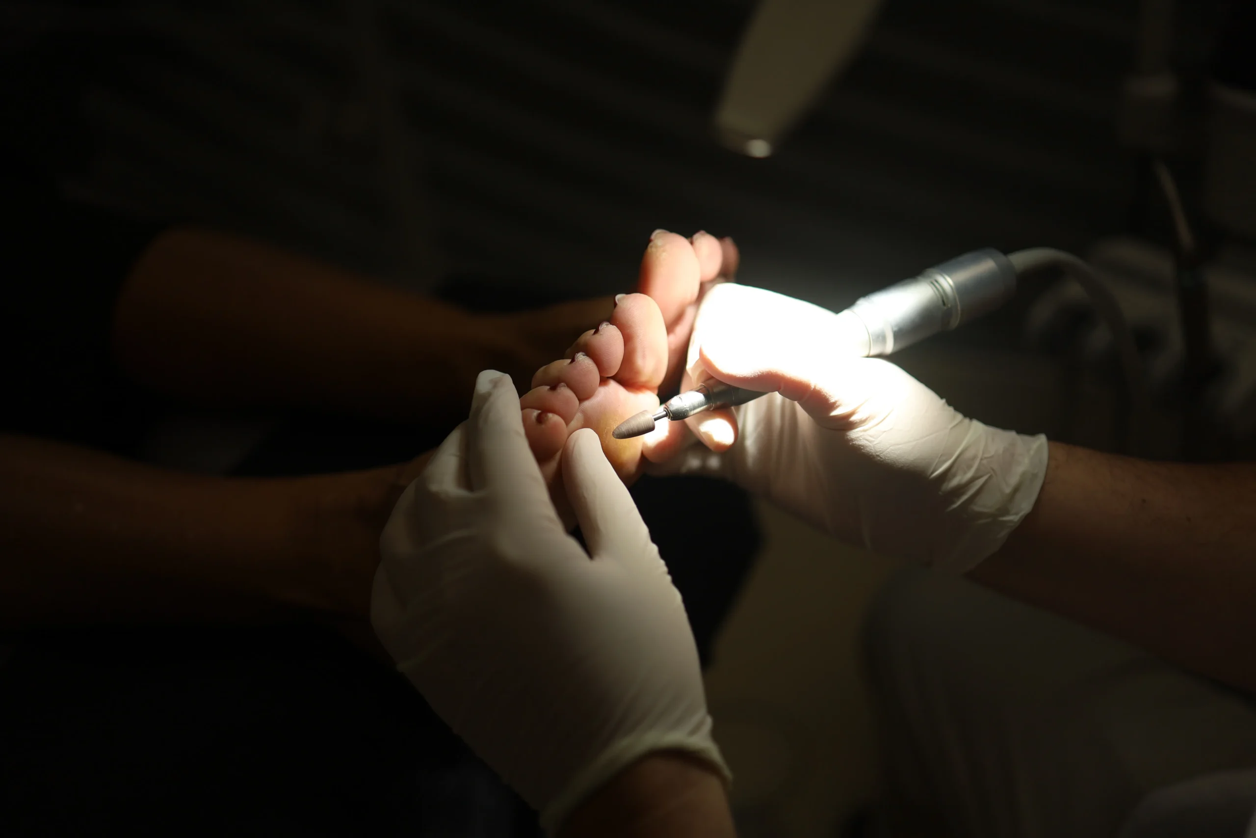 Ampollas en los pies, evítalas en Málaga